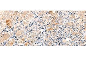 Immunohistochemistry of paraffin-embedded Human liver cancer tissue using THNSL1 Polyclonal Antibody at dilution of 1:70(x200) (THNSL1 anticorps)