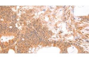 Immunohistochemistry of paraffin-embedded Human colon cancer tissue using TNF beta Polyclonal Antibody at dilution 1:50 (LTA anticorps)