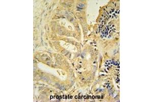 TLL1 antibody (C-term) immunohistochemistry analysis in formalin fixed and paraffin embedded human prostate carcinoma followed by peroxidase conjugation of the secondary antibody and DAB staining.
