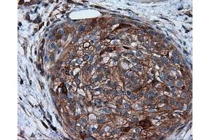 Immunohistochemical staining of paraffin-embedded Carcinoma of liver tissue using anti-RC201933 mouse monoclonal antibody. (PIM2 anticorps)