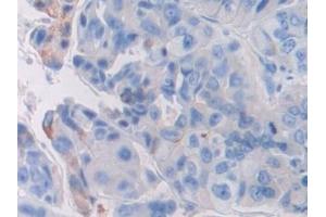 Detection of FGFR3 in Human Breast cancer Tissue using Polyclonal Antibody to Fibroblast Growth Factor Receptor 3 (FGFR3)