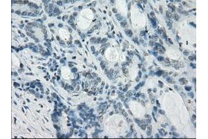 Immunohistochemical staining of paraffin-embedded Adenocarcinoma of colon tissue using anti-CRYABmouse monoclonal antibody. (CRYAB anticorps)