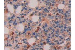 Detection of IL16 in Human Skin cancer Tissue using Polyclonal Antibody to Interleukin 16 (IL16)