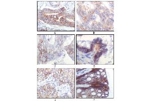 Immunohistochemical analysis of paraffin-embedded human gastric adenocarcinoma(A), colon adenocarcinoma(B), endometrial carcinoma(uterus)(C), ovary adenocarcinoma(D), lung squamous cell carcinoma(E), stomach epithelium mucosae(F), showing membrane localization using IGF1R-Beta mouse mAb with DAB staining. (IGF1R-beta anticorps)