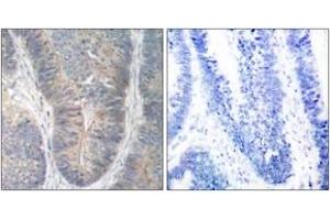 Immunohistochemistry analysis of paraffin-embedded human colon carcinoma, using PKR (Phospho-Thr451) Antibody.