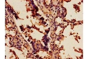 Immunohistochemistry of paraffin-embedded human lung cancer using ABIN7143196 at dilution of 1:100 (SCD anticorps  (AA 10-70))