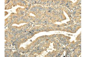 The image on the left is immunohistochemistry of paraffin-embedded Human esophagus cancer tissue using ABIN7131516(TULP2 Antibody) at dilution 1/20, on the right is treated with fusion protein. (TULP2 anticorps)