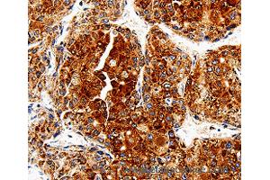 Immunohistochemistry of Human liver cancer using COX19 Polyclonal Antibody at dilution of 1:50 (COX19 anticorps)