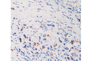 IHC-P analysis of stomach cancer tissue, with DAB staining. (FIL1d anticorps  (AA 12-151))