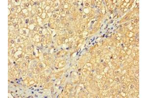 Immunohistochemistry of paraffin-embedded human liver cancer using ABIN7166961 at dilution of 1:100 (RABGAP1L anticorps  (Isoform 10))