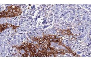 ABIN6278038 at 1/100 staining Human Head and neck cancer tissue by IHC-P. (CD72 anticorps  (Internal Region))