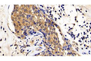 Detection of XIAP in Human Breast cancer Tissue using Polyclonal Antibody to X-linked Inhibitor Of Apoptosis Protein (XIAP)
