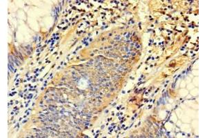 Immunohistochemistry of paraffin-embedded human colon cancer using ABIN7171165 at dilution of 1:100 (SYTL3 anticorps  (AA 1-300))