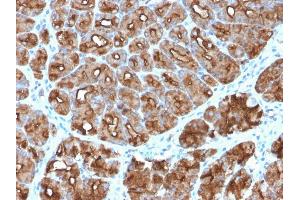 Formalin-fixed, paraffin-embedded human Stomach Carcinoma stained with MUC1 Rabbit Recombinant Monoclonal Antibody (MUC1/2818R). (Recombinant MUC1 anticorps)