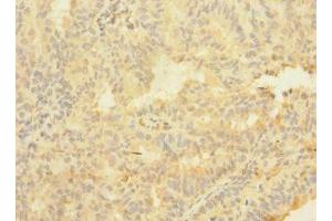 Immunohistochemistry of paraffin-embedded human endometrial cancer using ABIN7144765 at dilution of 1:100 (ASTL anticorps  (AA 38-337))