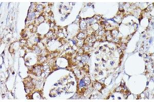 Immunohistochemistry of paraffin-embedded Human colon carcinoma using CDK5RAP1 Polyclonal Antibody at dilution of 1:100 (40x lens).
