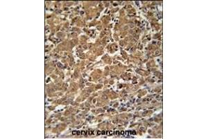 N4BP3 Antibody (N-term) (ABIN651821 and ABIN2840413) immunohistochemistry analysis in formalin fixed and paraffin embedded human cervix carcinoma followed by peroxidase conjugation of the secondary antibody and DAB staining. (N4BP3 anticorps  (N-Term))