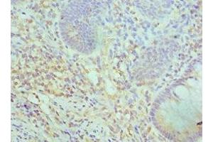 Immunohistochemistry of paraffin-embedded human colon cancer using ABIN7171057 at dilution of 1:100 (SMARCC2 anticorps  (AA 300-650))