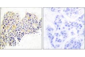 Immunohistochemistry analysis of paraffin-embedded human breast carcinoma tissue, using HSP90B (Ab-254) Antibody.