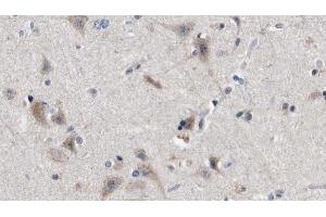 ABIN6272845 at 1/100 staining Human brain cancer tissue by IHC-P. (IFT88 anticorps  (C-Term))