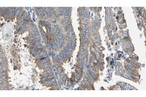 ABIN6274763 at 1/100 staining Human cervical cancer tissue by IHC-P. (AZI1 anticorps  (C-Term))