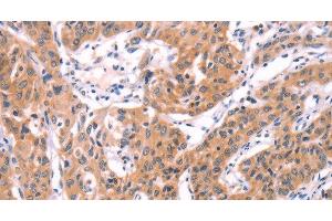 Immunohistochemistry of paraffin-embedded Human lung cancer using SERPINA5 Polyclonal Antibody at dilution of 1:40 (SERPINA5 anticorps)