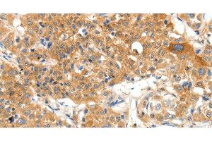 Immunohistochemistry of paraffin-embedded Human lung cancer using PLAT Polyclonal Antibody at dilution of 1:50 (PLAT anticorps)