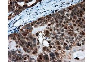 Immunohistochemical staining of paraffin-embedded Adenocarcinoma of breast tissue using anti-SRR mouse monoclonal antibody. (SRR anticorps)