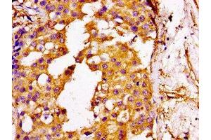 IHC image of ABIN7175537 diluted at 1:100 and staining in paraffin-embedded human breast cancer performed on a Leica BondTM system. (GGCX anticorps  (AA 383-526))