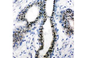 IHC analysis of Estrogen Receptor using anti-Estrogen Receptor antibody (ABIN3042378).