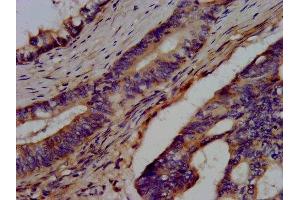 IHC image of ABIN7145758 diluted at 1:300 and staining in paraffin-embedded human colon cancer performed on a Leica BondTM system.