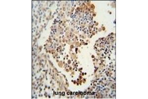 CADM1 antibody (N-term) (ABIN654660 and ABIN2844356) immunohistochemistry analysis in formalin fixed and paraffin embedded human lung carcinoma followed by peroxidase conjugation of the secondary antibody and DAB staining. (CADM1 anticorps  (N-Term))