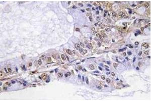 Immunohistochemistry (IHC) analyzes of p-Cofilin in paraffin-embedded human lung carcinoma tissue. (Cofilin anticorps  (pSer3))