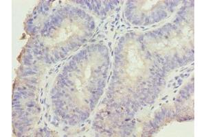Immunohistochemistry of paraffin-embedded human endometrial cancer using ABIN7165250 at dilution of 1:100 (DDI2 anticorps  (AA 1-211))