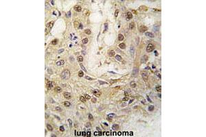 Formalin-fixed and paraffin-embedded human lung carcinomareacted with PRKG2 polyclonal antibody , which was peroxidase-conjugated to the secondary antibody, followed by AEC staining.