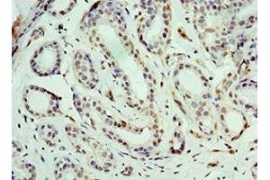 Immunohistochemistry of paraffin-embedded human breast cancer using ABIN7164185 at dilution of 1:100 (BCAS2 anticorps  (AA 1-225))