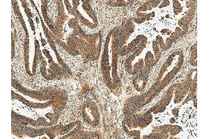 Immunohistochemistry analysis using Rabbit Anti-MDM2 Polyclonal Antibody (ABIN5667992).