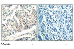 Immunohistochemical analysis of paraffin-embedded human breast carcinoma tissue using ABL1/ABL2 (phospho Y393/429) polyclonal antibody . (ABL1 anticorps  (pTyr393, pTyr429))