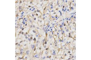 Immunohistochemistry of paraffin-embedded human kidney cancer using PPP2R4 Antibody. (PPP2R4 anticorps)