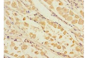 Immunohistochemistry of paraffin-embedded human gastric cancer using ABIN7168232 at dilution of 1:100
