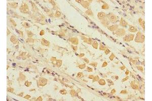Immunohistochemistry of paraffin-embedded human gastric cancer using ABIN7168232 at dilution of 1:100 (RCHY1 anticorps  (AA 1-261))