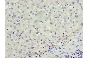 Immunohistochemistry of paraffin-embedded human liver cancer using ABIN7151358 at dilution of 1:100 (ENOX1 anticorps  (AA 101-340))