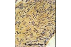 MURC Antibody (N-term) (ABIN651833 and ABIN2840416) immunohistochemistry analysis in formalin fixed and paraffin embedded human lung carcinoma followed by peroxidase conjugation of the secondary antibody and DAB staining.
