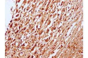 IHC image of ABIN7127796 diluted at 1:100 and staining in paraffin-embedded human melanoma cancer performed on a Leica BondTM system.