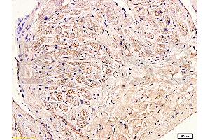 Formalin-fixed and paraffin embedded human myocardium tissue labeled with Anti-Collagen III Polyclonal Antibody (ABIN669981), Unconjugated at 1:400, followed by conjugation to the secondary antibody and DAB staining (COL3 anticorps  (AA 1301-1400))