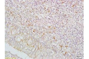 Formalin-fixed and paraffin embedded human nasopharyngeal carcinoma labeled with Anti-IGFBP5/IBP5 Polyclonal Antibody , Unconjugated at 1:200, followed by conjugation to the secondary antibody and DAB staining (IGFBP5 anticorps  (AA 101-200))