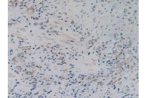 IHC-P analysis of Human Prostate Gland Cancer Tissue, with DAB staining. (C1QBP anticorps  (AA 76-282))