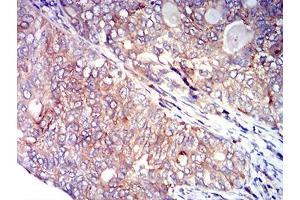 Immunohistochemical analysis of paraffin-embedded cervical cancer tissues using CD134 mouse mAb with DAB staining.