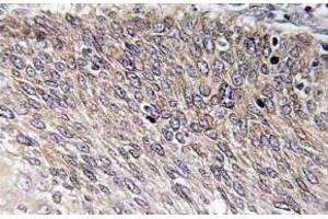 Immunohistochemistry (IHC) analyzes of p-VASP antibody in paraffin-embedded human cervix carcinoma tissue. (VASP anticorps  (pSer238))