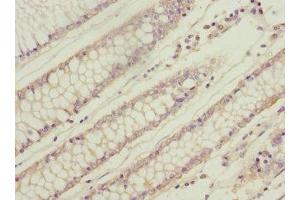 Immunohistochemistry of paraffin-embedded human colon cancer using ABIN7166319 at dilution of 1:100 (WNT9A anticorps  (AA 206-365))